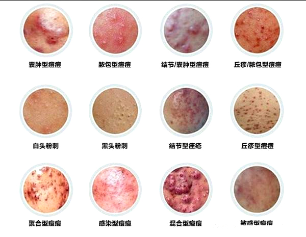 了解9大常见痘痘类型，助力对症祛痘，祛痘更高效--香港妮雨康肤堂 祛痘祛斑 护肤小常识