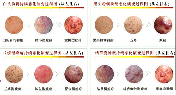 了解9大常见痘痘类型，助力对症祛痘，祛痘更高效--香港妮雨康肤堂 祛痘祛斑 护肤小常识