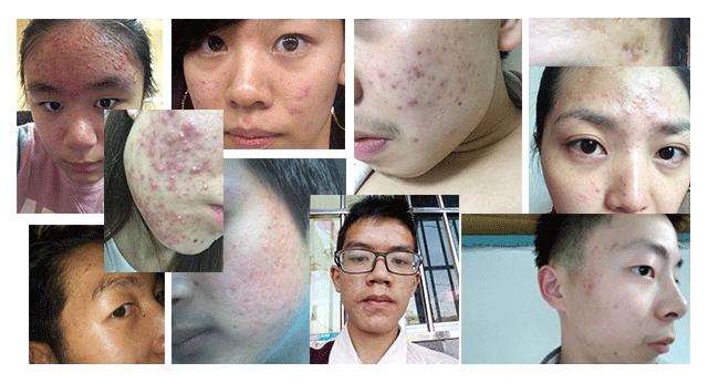 长痘痘怎么去除?青春痘怎么治? 长痘痘怎么去除?青春痘怎么治?